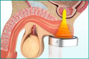 Prostatitis treatment