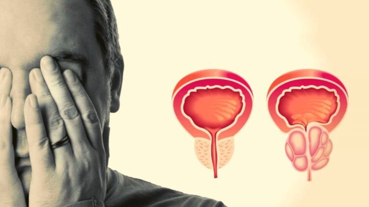 The man has prostatitis
