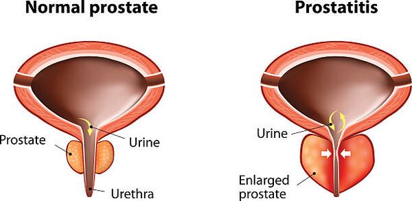Normal and prostate on