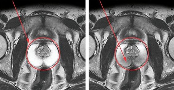 Normal prostate (left) and prostatitis with prostatitis (right)